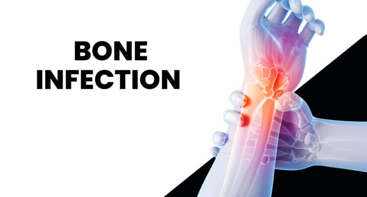 Bone Infections