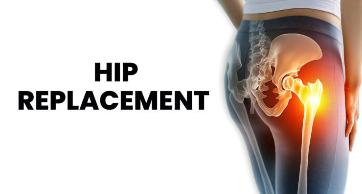 Hip Replacement